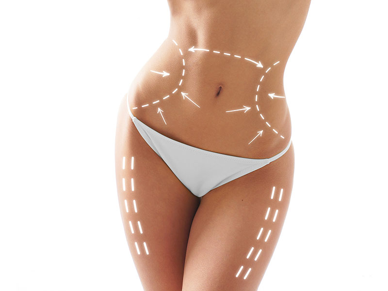 Liposuccion laser - SmartLipo