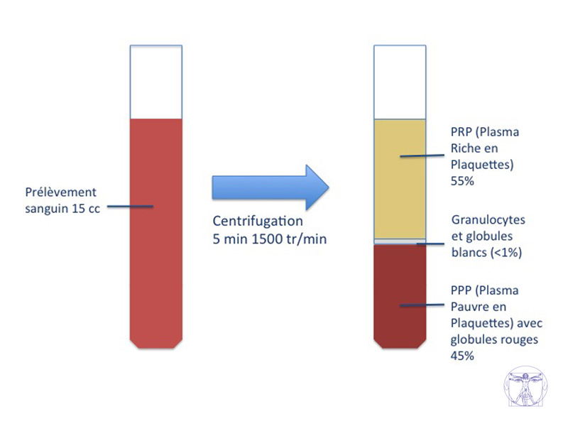 Extraction du plasma - PRP
