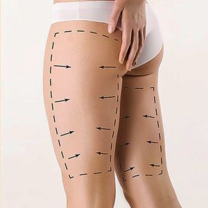 Liposuccion