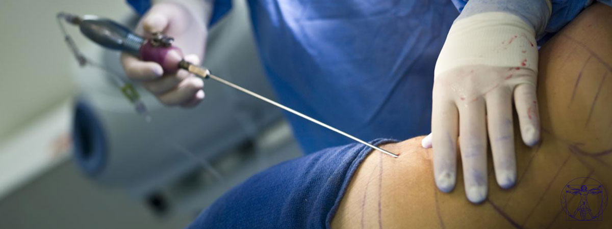 L'intervention chirurgicale en liposuccion L'intervention chirurgicale en liposuccion