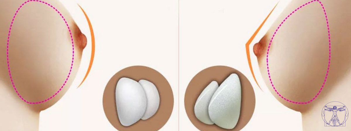 Types d'implant mammaire  