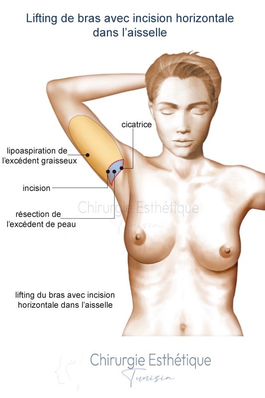 Lifting de bras avec incision horizontale dans l’aisselle