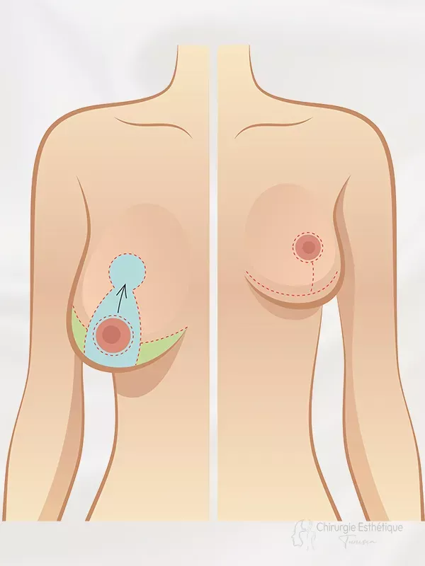 6c8c-breast-33-cet-1d68536b Réduction mammaire