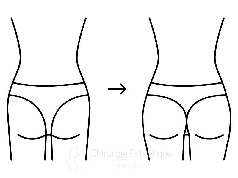 Schéma augmentation des fesses