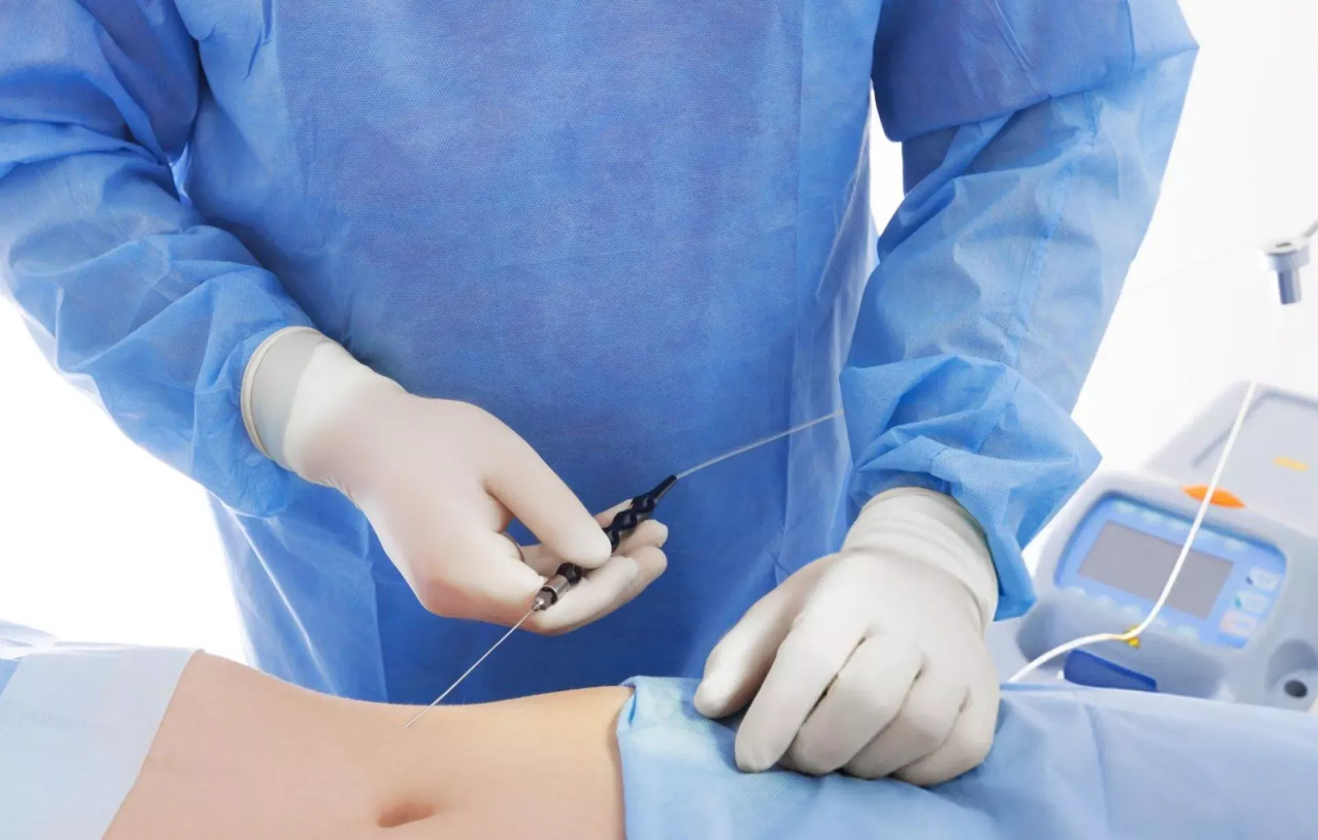 Laser Lipolysis