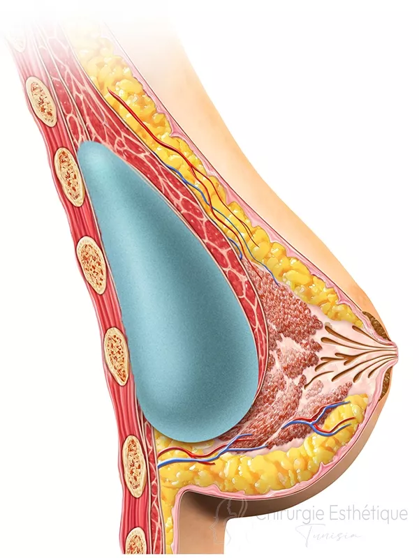 Prothèse mammaire sous musculaire