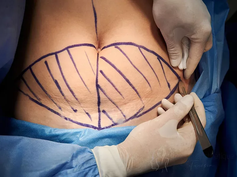 Abdominoplastie
