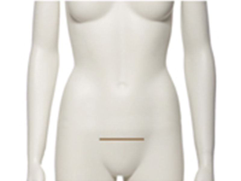 Abdominoplastie Cicatrice