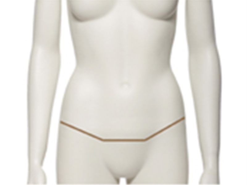Abdominoplastie Cicatrice
