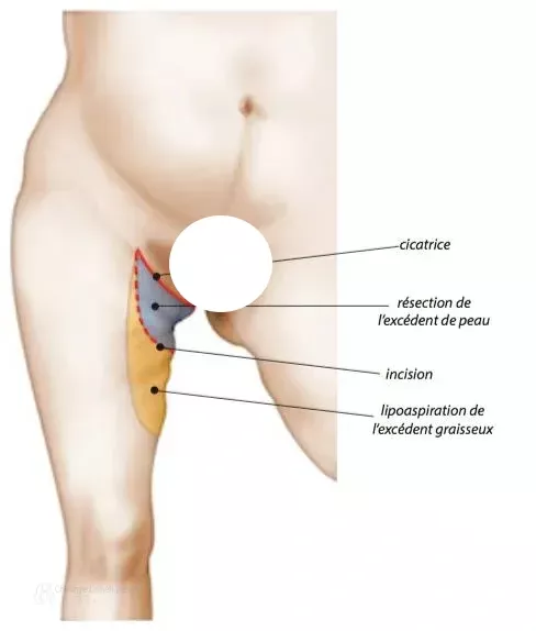 Technique horizontale ou mixte de face