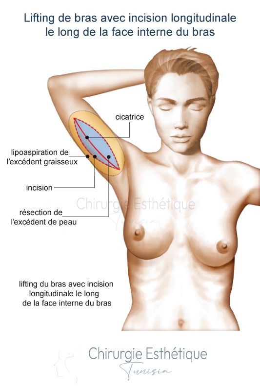 Lifting de bras avec incision longitudinale le long de la face interne du bras