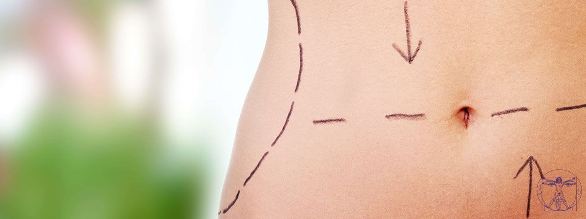 Liposuccion