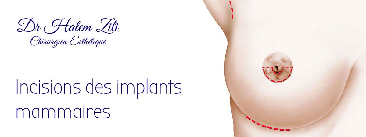 Incisions des implants mammaires