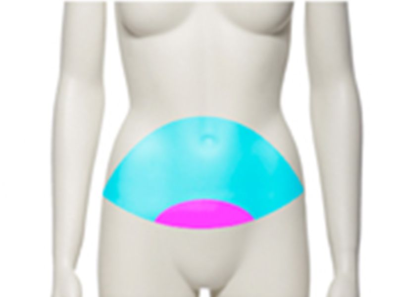 Abdominoplastie décollement