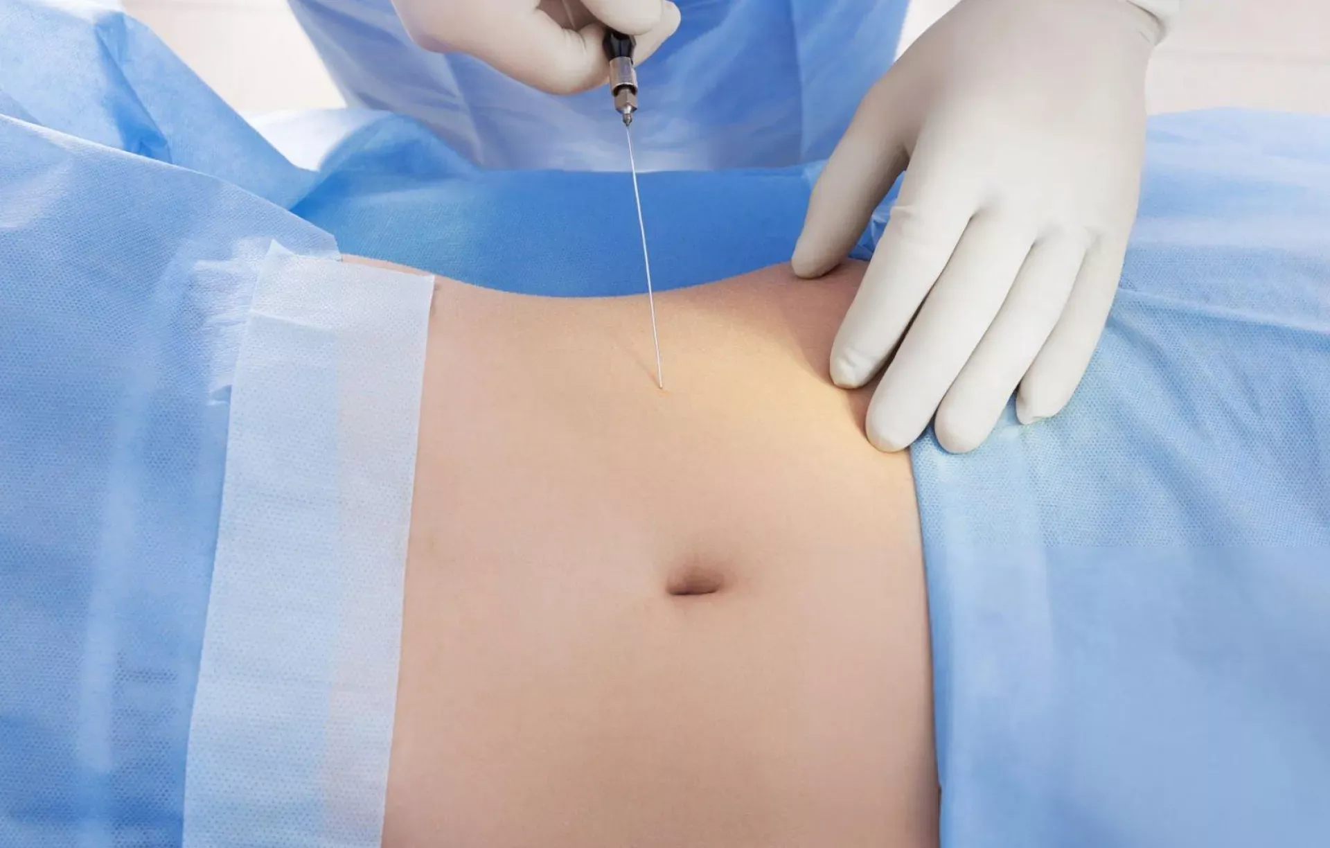 Laser Lipolysis