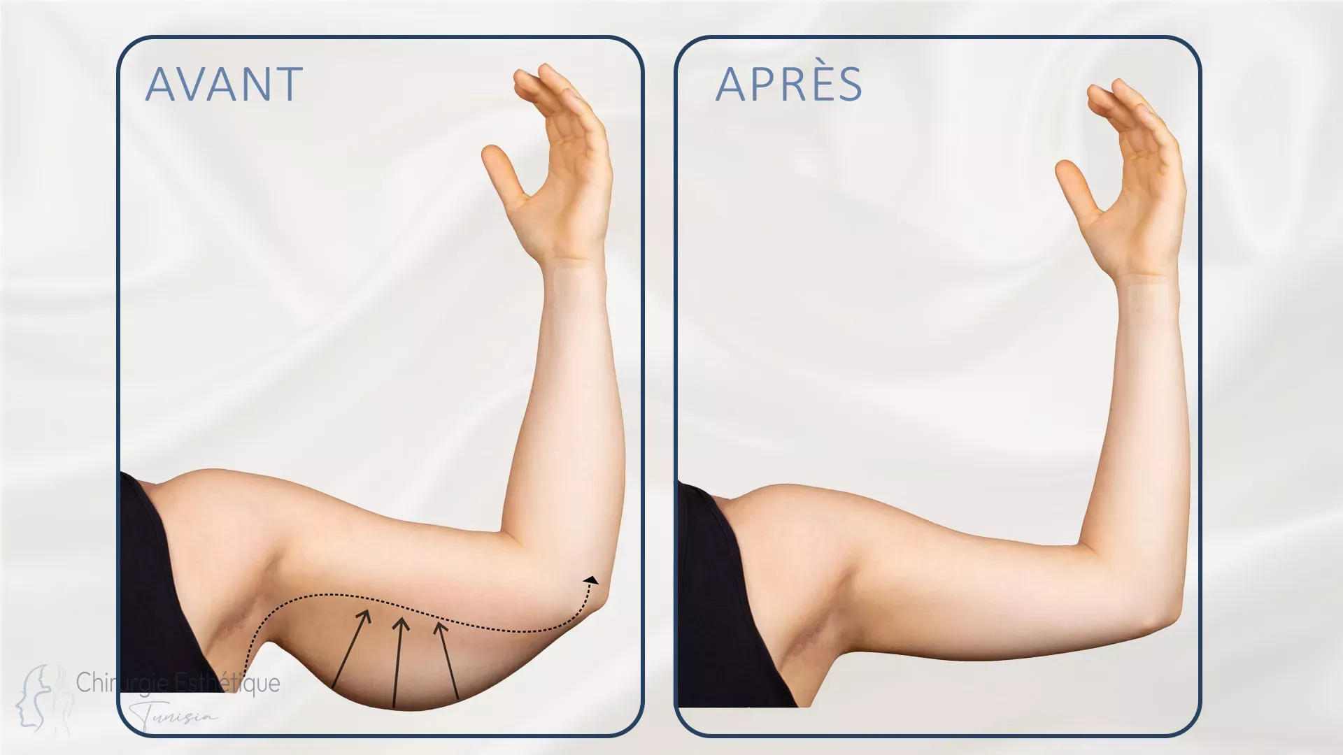 fhd-arms-02-cet-e5597434 Lifting des bras