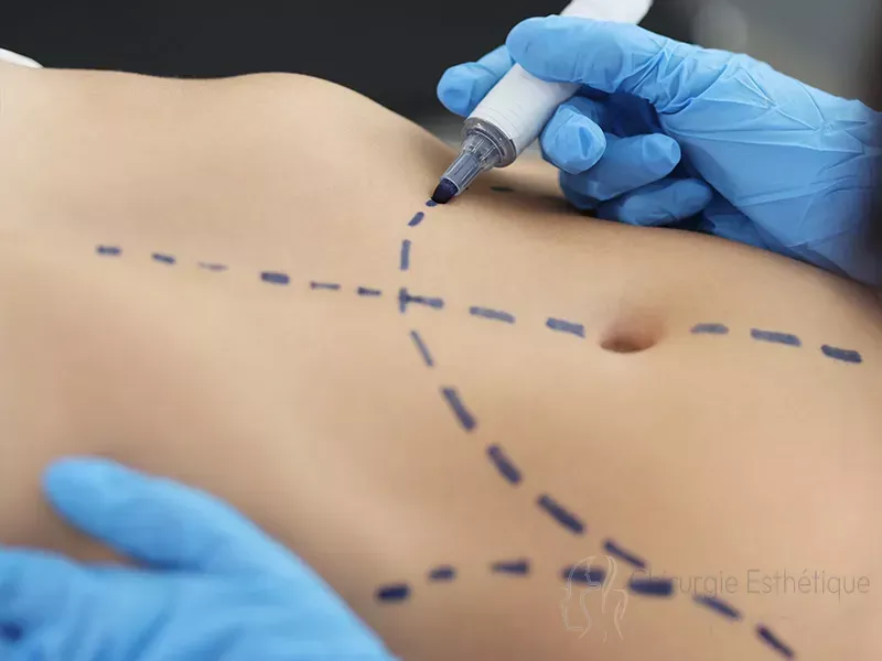 Abdominoplastie
