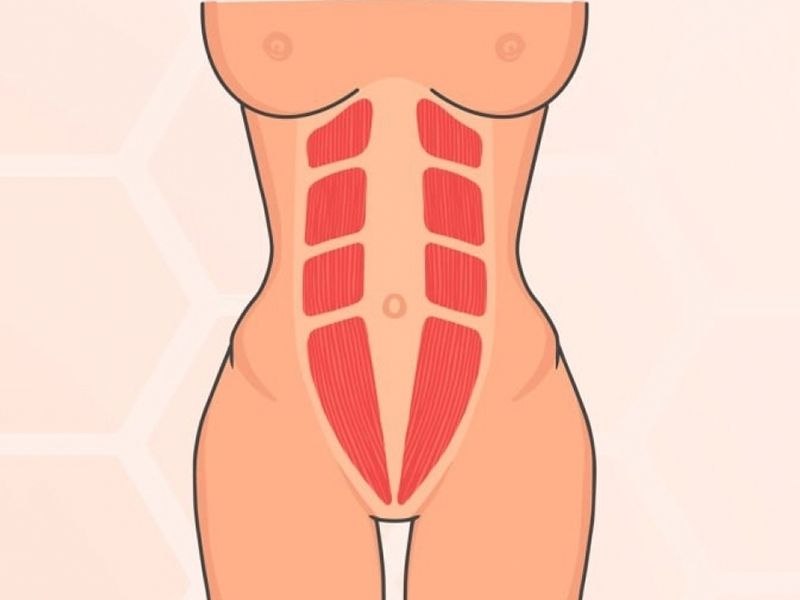 Diastasis des muscles droits abdominaux