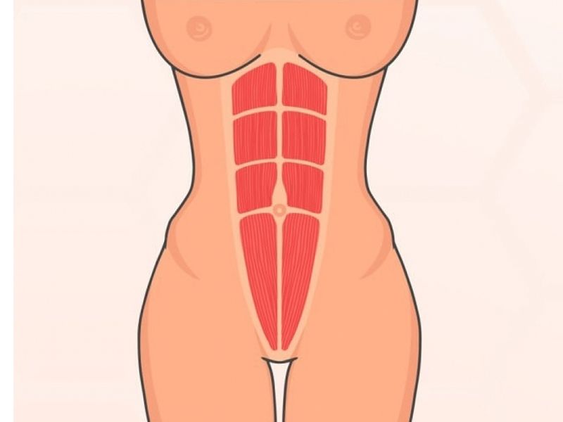 Diastasis des muscles droits abdominaux
